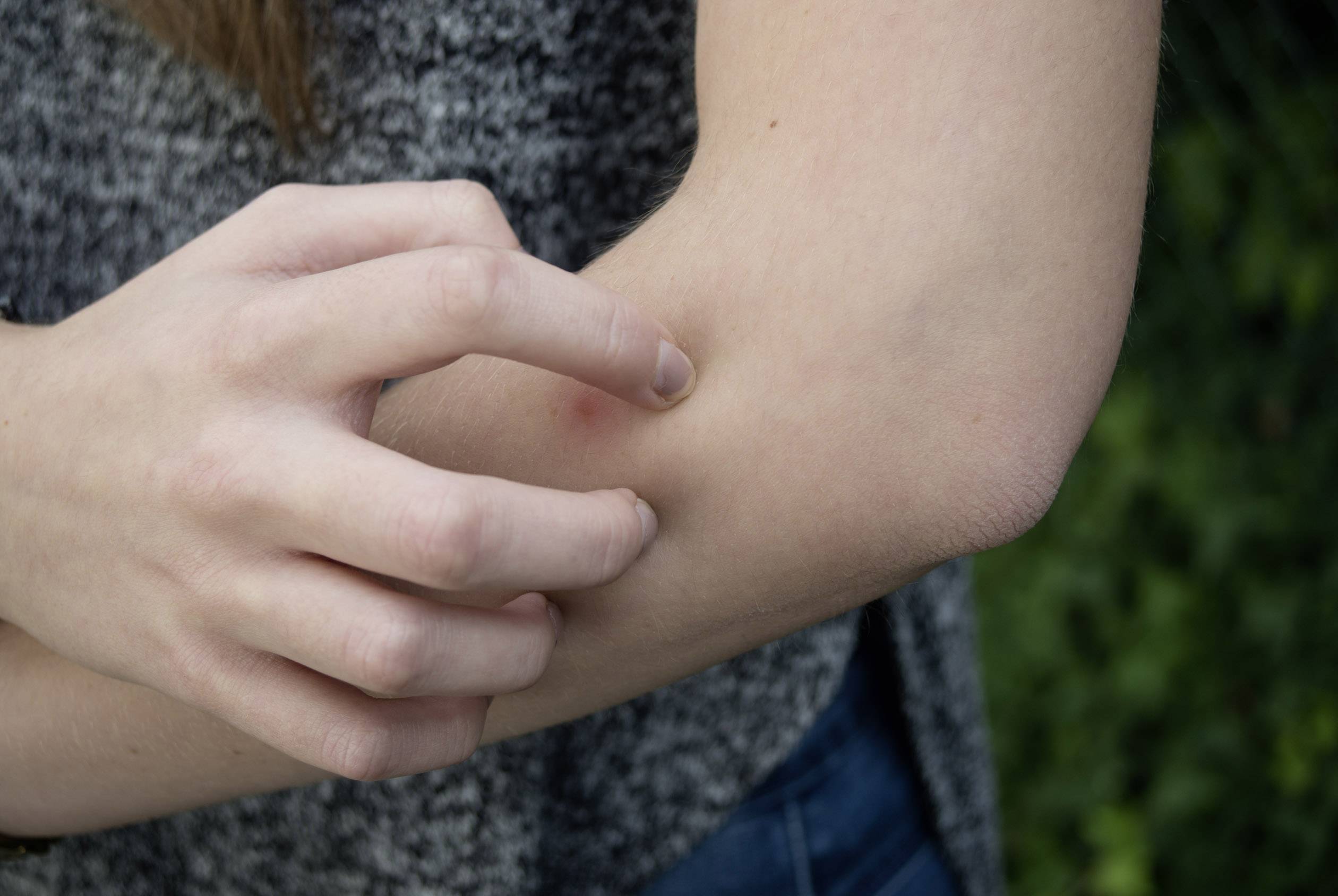 'Jemand kratzt sich am Unterarm', Bild zeigt eine Nahaufnahme einer Hand, die die Haut am Unterarm berührt.