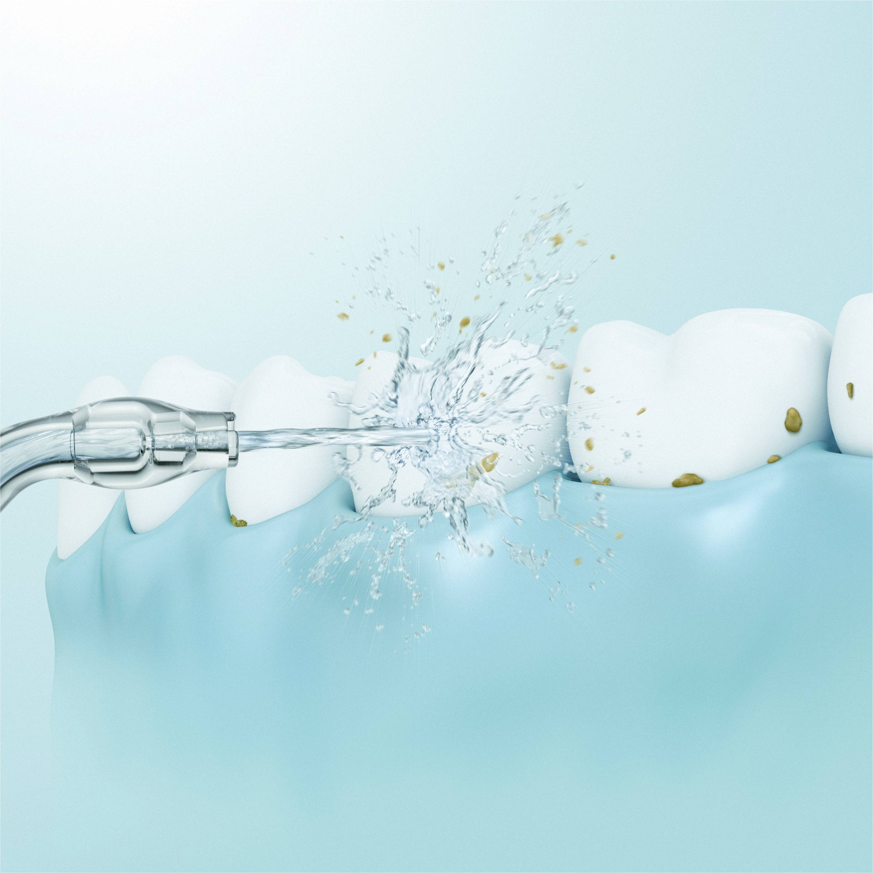 Illustration of a tooth with a water jet removing tartar. Representation of tooth cleaning and oral hygiene.