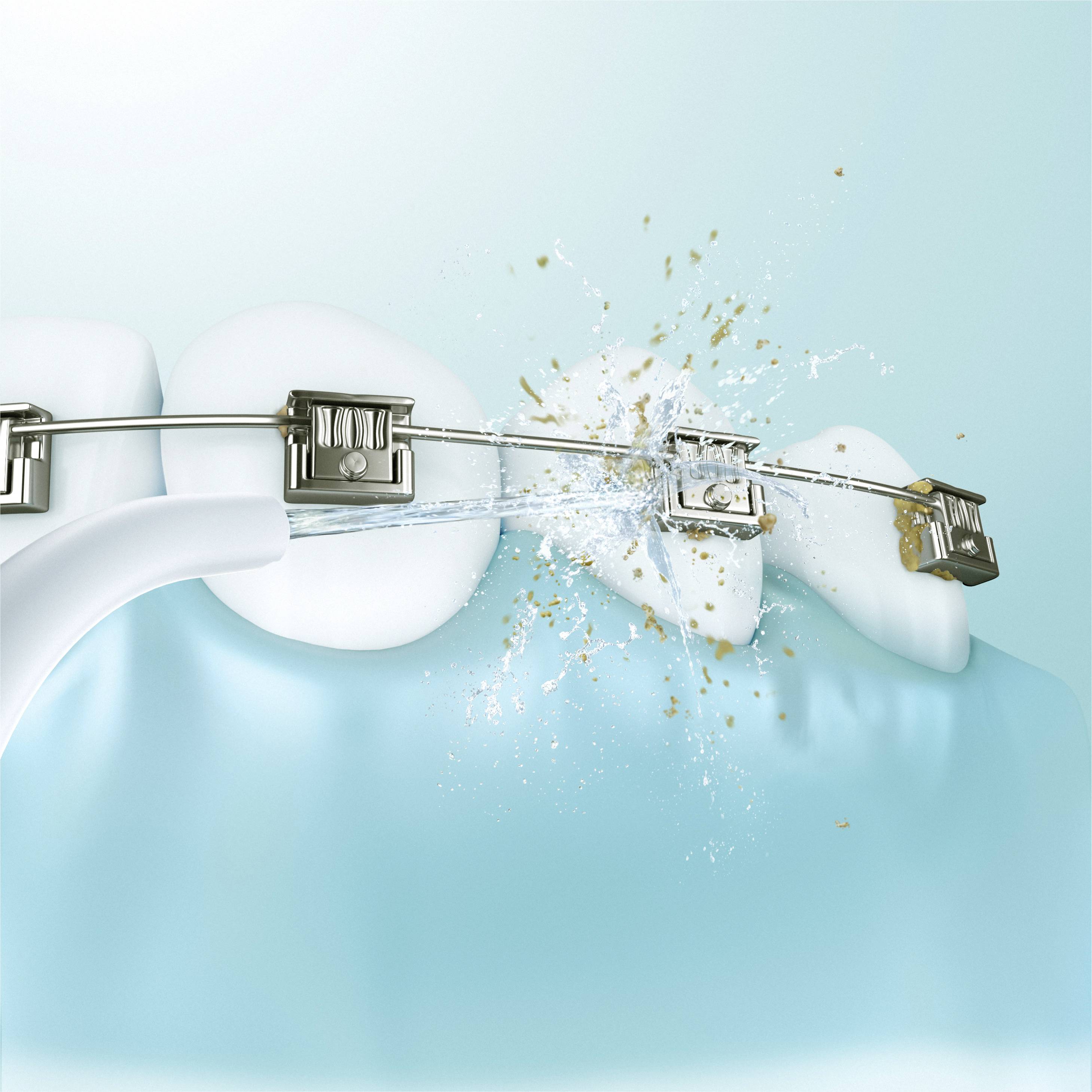 A water jet cleaner removes deposits from braces on teeth, demonstrating effective cleaning and brace care.