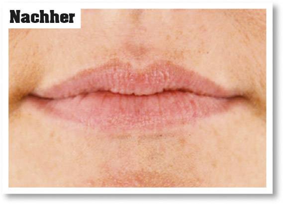 Close-up of a mouth with the text 'After' in the top left corner, possibly a result image following a cosmetic treatment.