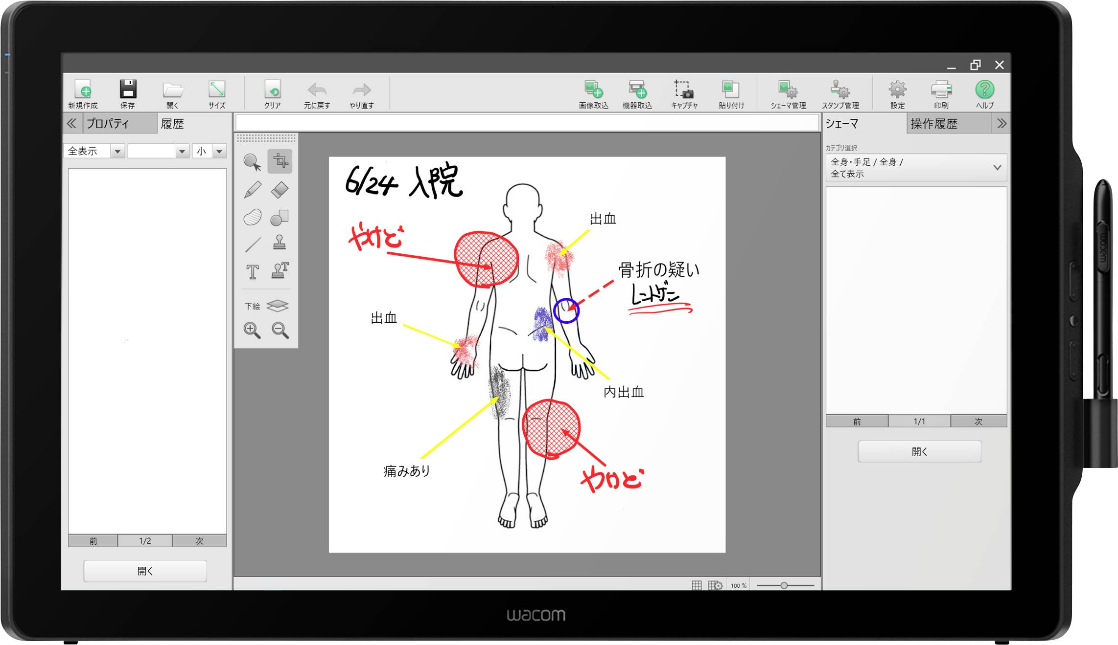 Diagramma medico su un tablet che mostra i punti del dolore alla schiena con annotazioni manoscritte in rosso e blu per la localizzazione del dolore.
