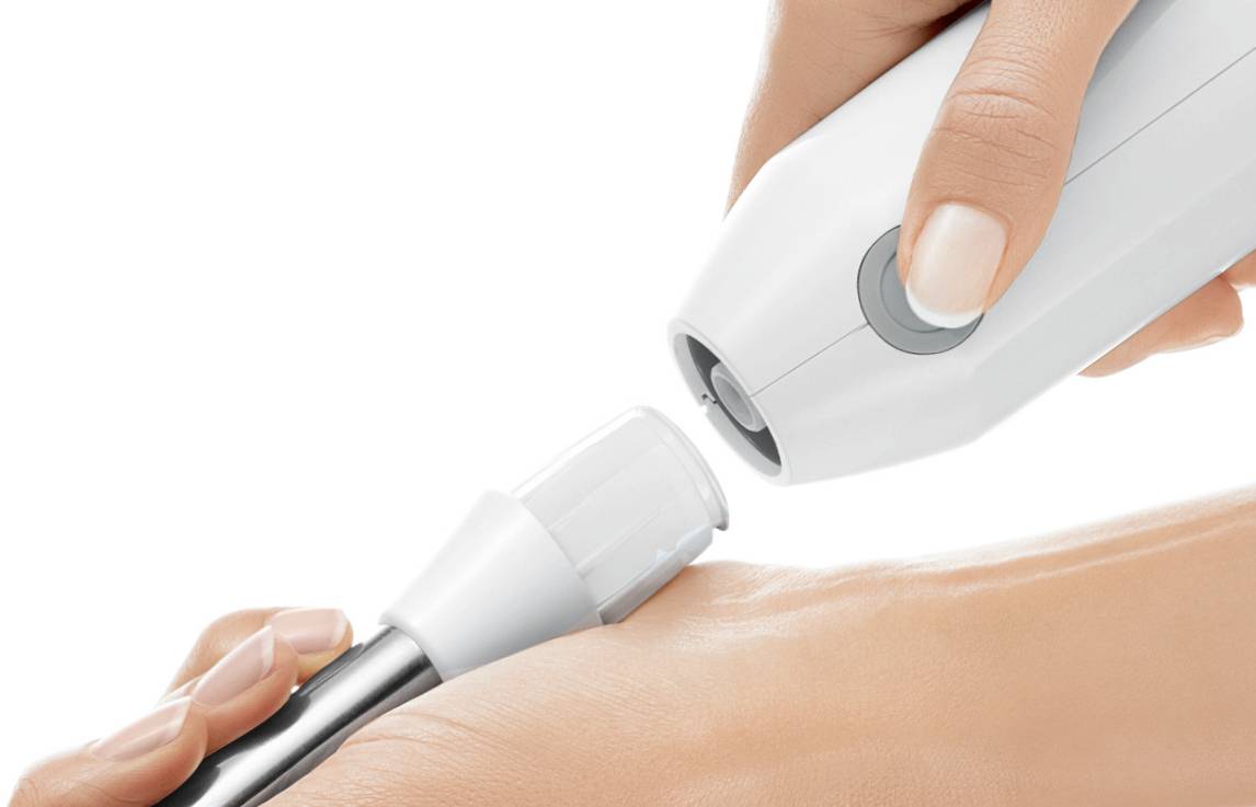 Een persoon gebruikt een draagbaar apparaat om een huidbehandeling uit te voeren op de achterkant van zijn hand, wat wijst op een schoonheids- of medische procedure.