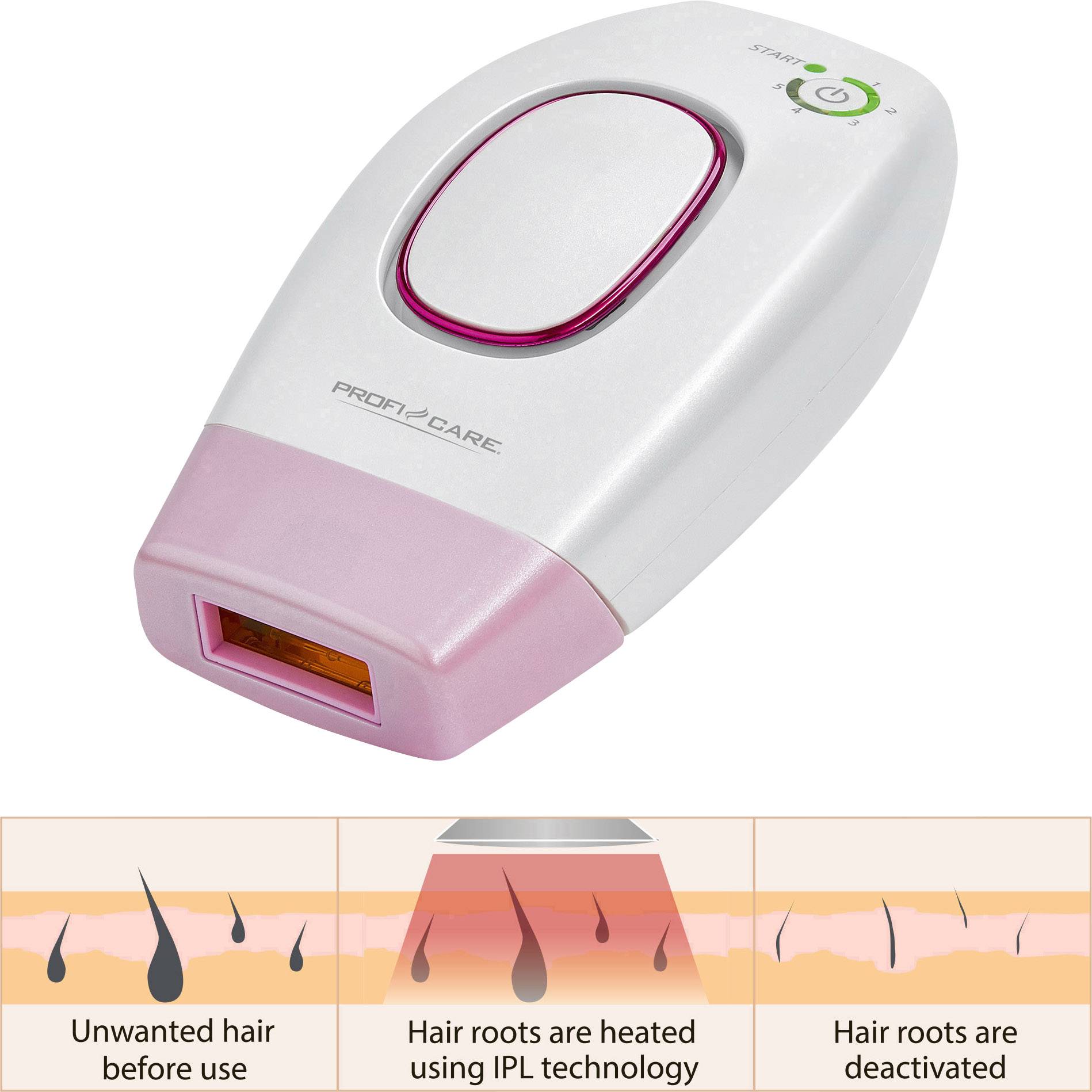 Een IPL-ontharing-apparaat wordt getoond dat haarwortels inactiveert door middel van lichtpulsen. Daaronder een diagram van het werkingsprincipe.